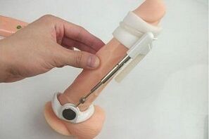 Verwendung eines Extenders zur Penisvergrößerung